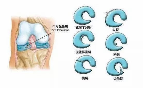 半月板到底是個(gè)什么“板”？-昭通李景鏵中醫(yī)骨傷醫(yī)院